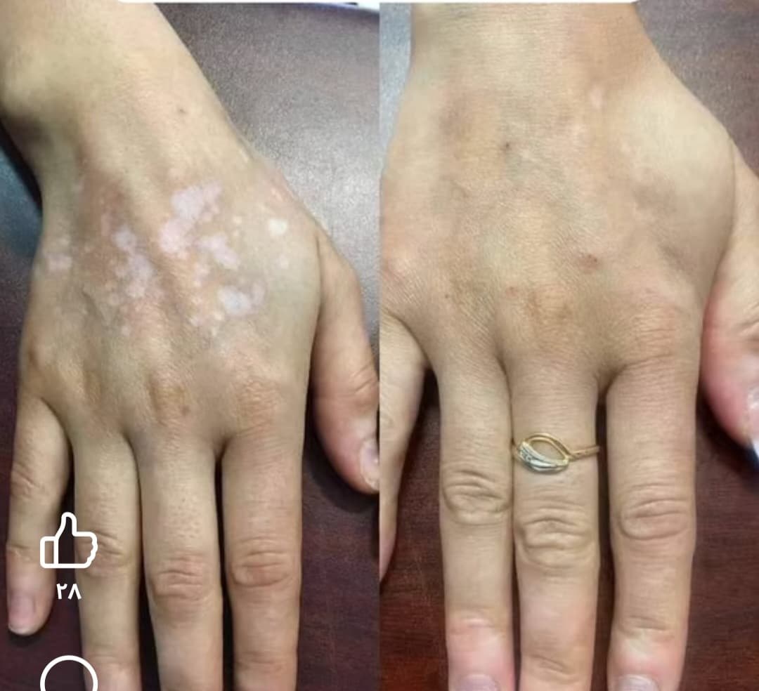 علاج البهاق  - صورة 4