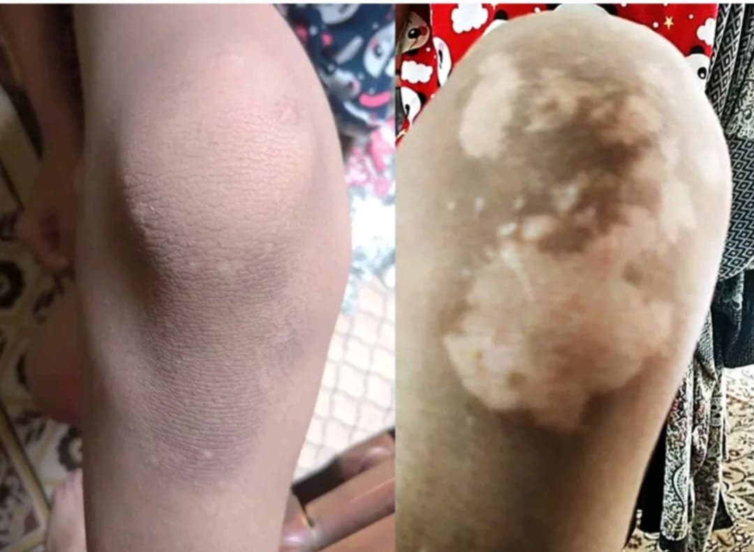 علاج البهاق  - صورة 5