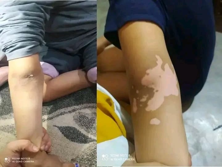 علاج البهاق  - التجميل والعناية  في بورتسودان