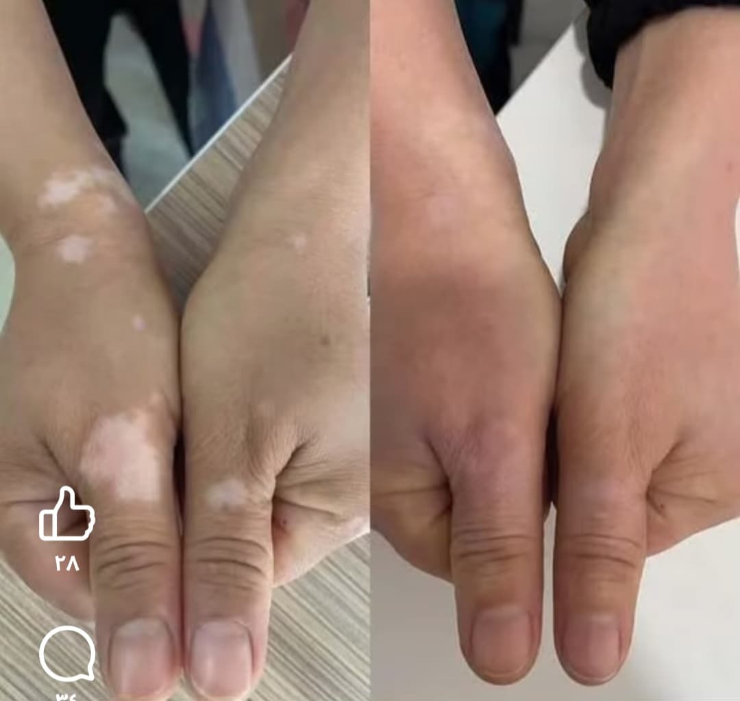 علاج البهاق  - صورة 3