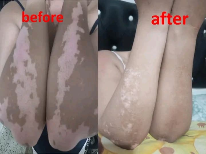 مجموعة علاج البهاق  - صورة 3