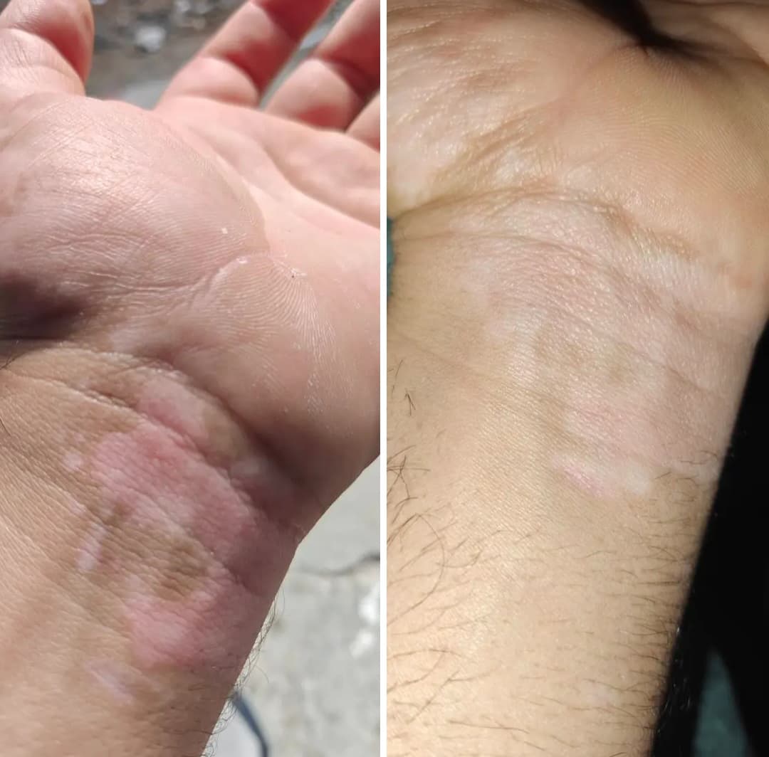 علاج البهاق  - صورة 2