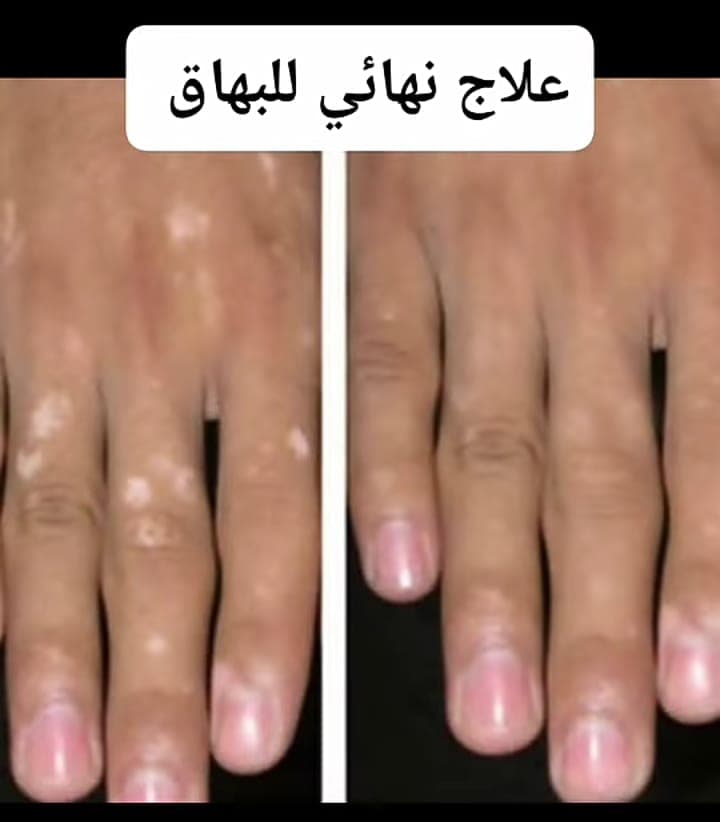 مجموعة علاج البهاق  - مستلزمات طبية في أم درمان