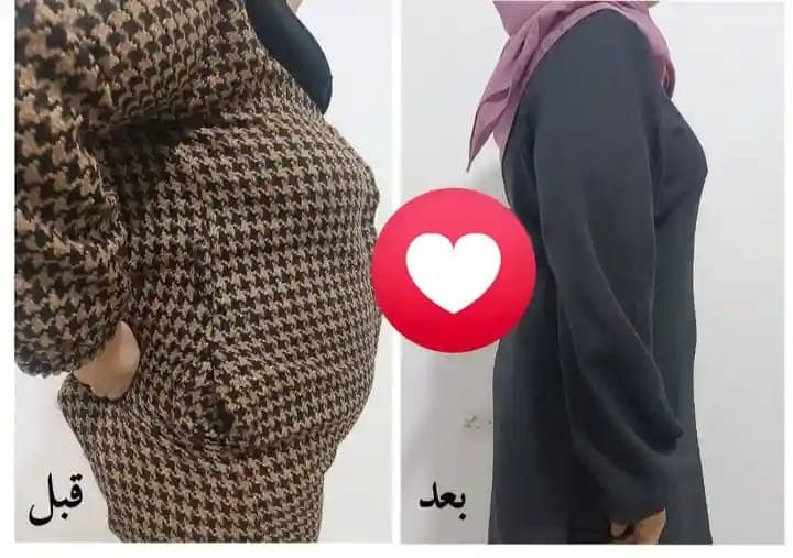 نظام بديل التكميم ومتابعة يومية لمدة شهر  - التجميل والعناية  في بورتسودان