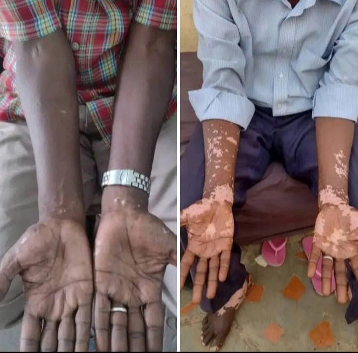 علاج البهاق  - صورة 6