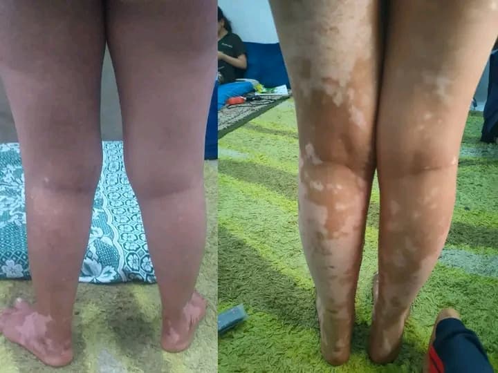 مجموعة علاج البهاق  - صورة 2